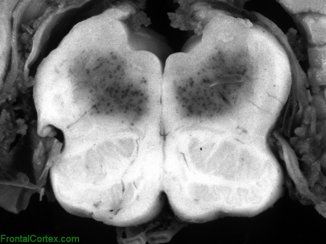 Hypotensive Brainstem Necrosis