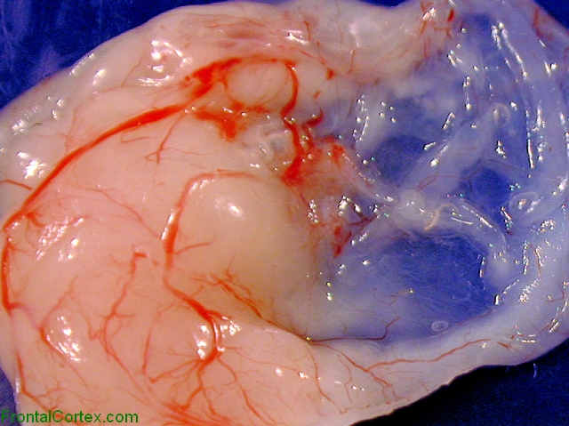 Cystic hypothalamic hamartoma, gross photographs of surgically resected tumor