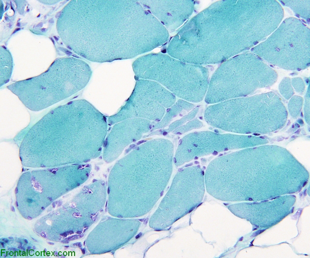 Inclusion body myositis, trichrome stain, low-power.