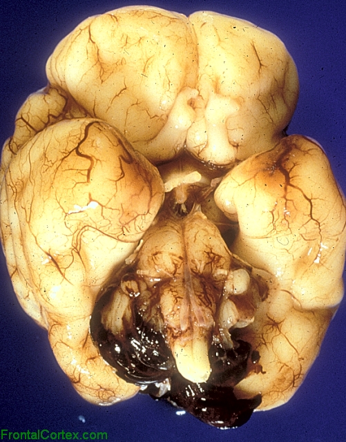 Intraventricular hemorrhage with subarachnoid extension, ventral surface of brain.