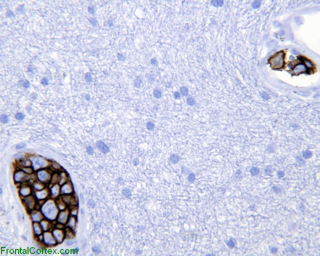 Intravascular lymphomatosis, CD20 immunohistochemical staining