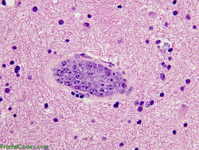 Intravascular lymphomatosis, H&E stain x 400