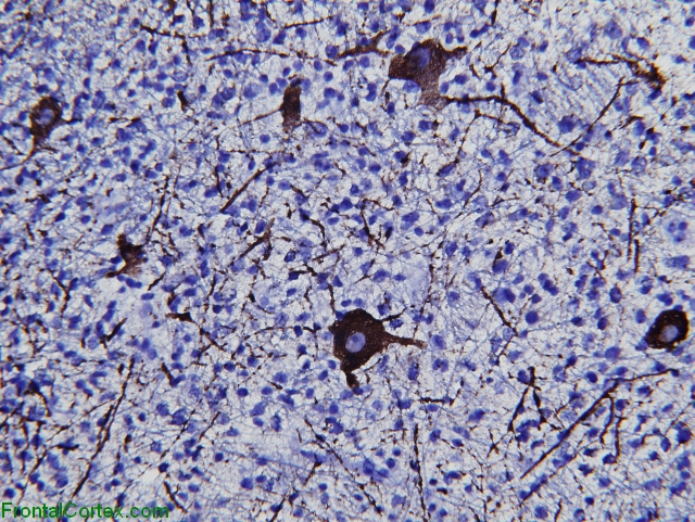 Infiltrating Glioma, Thalmus, neurofilament immunohistochemical staining x 200