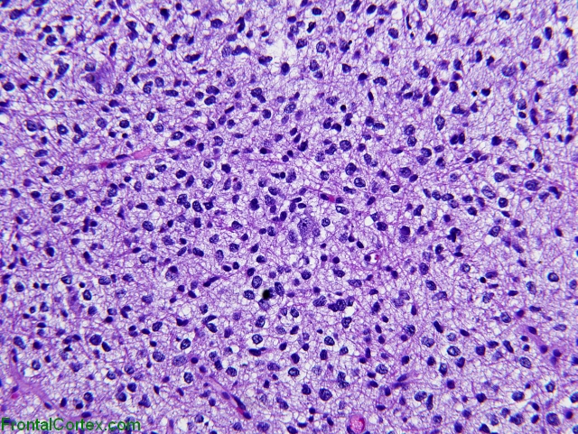 Inflitrating Glioma, Thalamus H&E stain x200