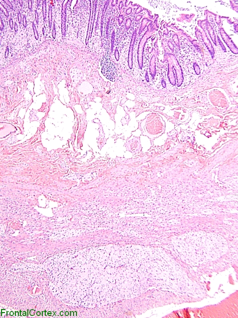 Intestinal Ganglioneuromatosis H&E