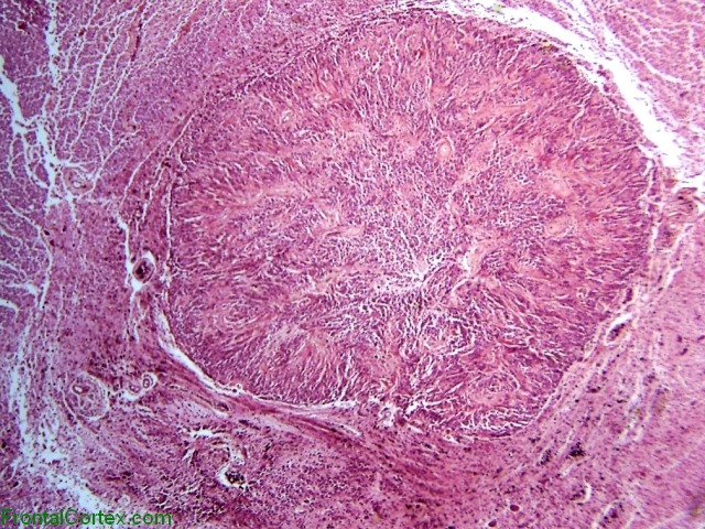 Intramedullary Ependymoma, transverse section through spinal cord, H&E stain x 40