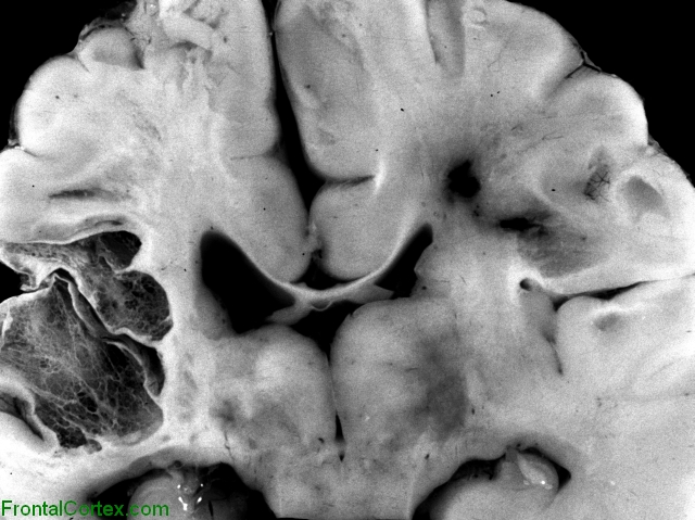 Intrauterine Infarct Coronal