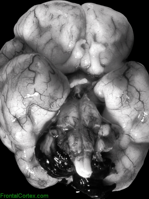 Intraventricular Hemorrhage vent