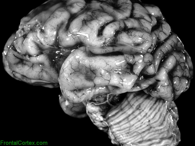 Ischemic Micrenceohaly Lateral