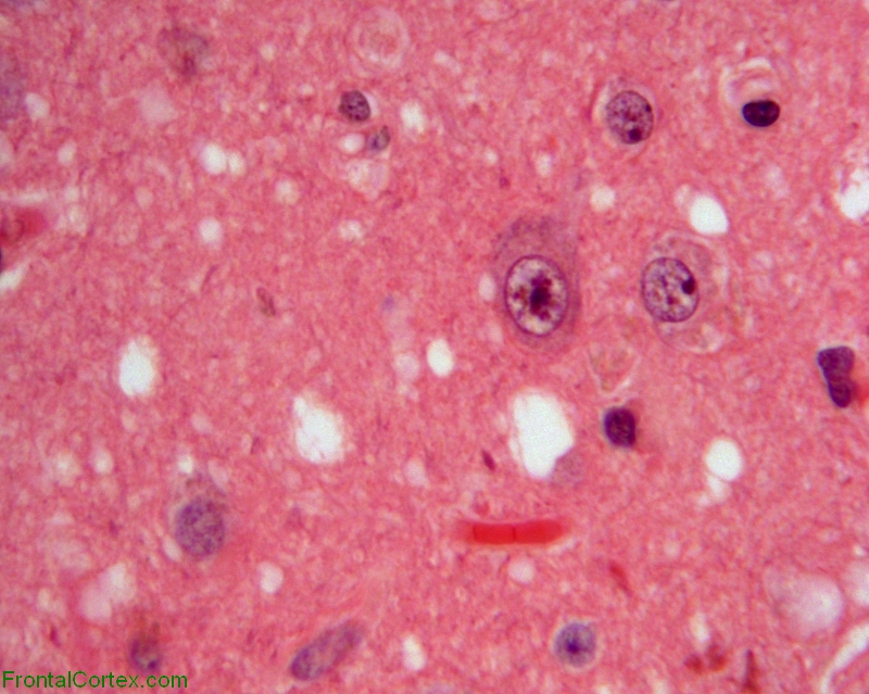 Sporadic Jakob-Creutzfeldt disease, stereotactic biopsy specimen, H&E stain x 400