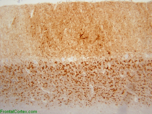 Sporadic Jakob-Creutzfeldt disease, cerebellum, 3F4 immunohistochemical staining x 100