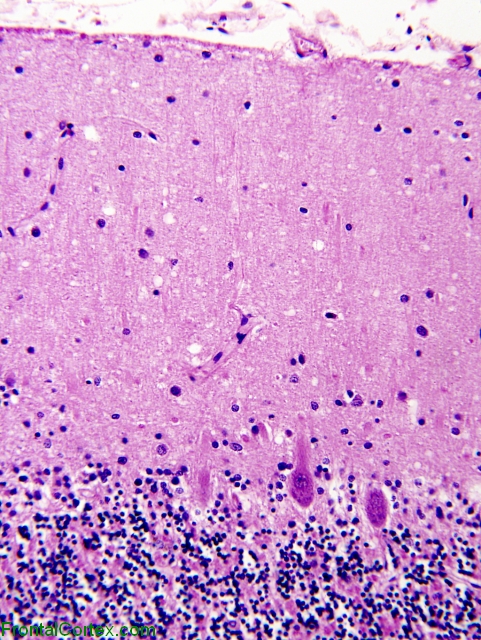 Sporadic Jakob-Creutzfeldt disease, cerebellum, H&E stain x 200