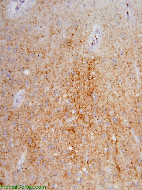 Sporadic Jakob-Creutzfeldt disease, occipital neocortex, 3F4 immunohistochemical staining x 200