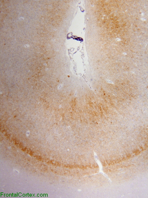 Sporadic Jakob-Creutzfeldt disease, occipital neocortex, 3F4 immunohistochemical staining x 40