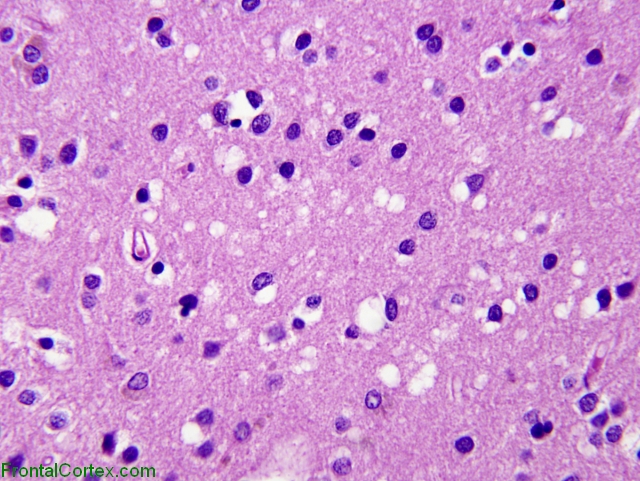 Sporadic Jakob-Creutzfeldt disease, occipital lobe neocortex, H&E stain x 200