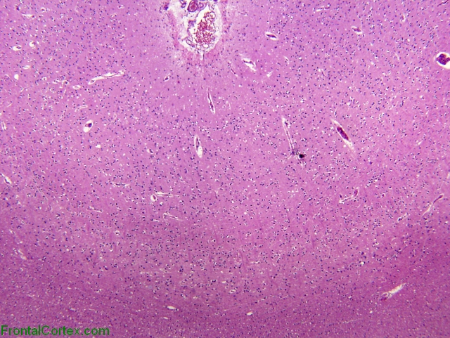 Sporadic Jakob-Creutzfeldt disease, occipital lobe neocortex, H&E stained x 40