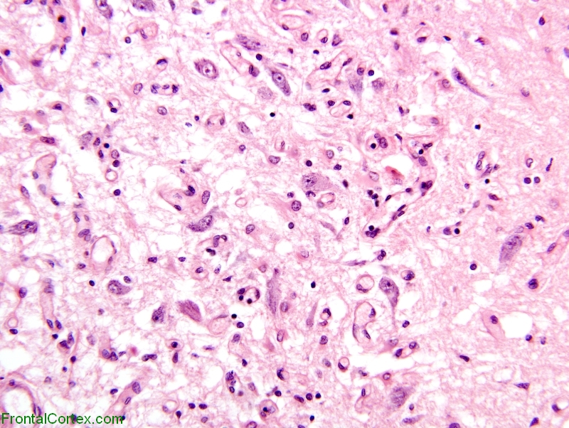 Kearns-Sayre syndrome, H&E section of substantia nigra x 200