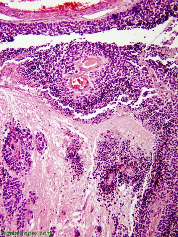 Leptomeningeal dissemination of germinoma, H&E stained section x 40