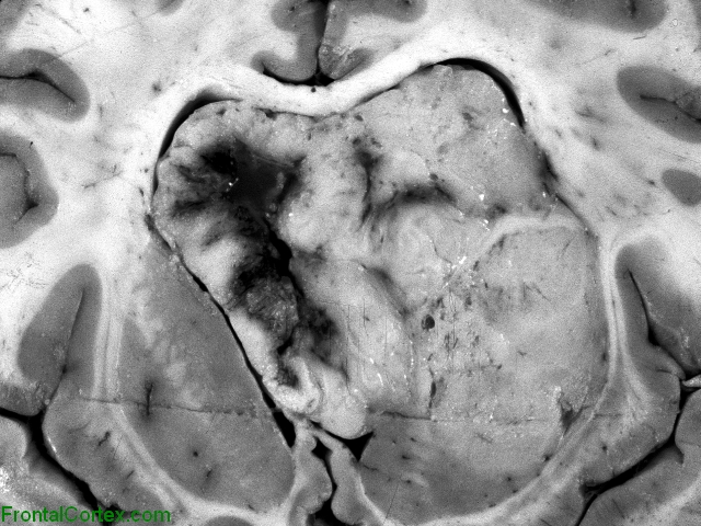 Ependymoma involving lateral ventricle, coronal section at the level of the basal ganglia