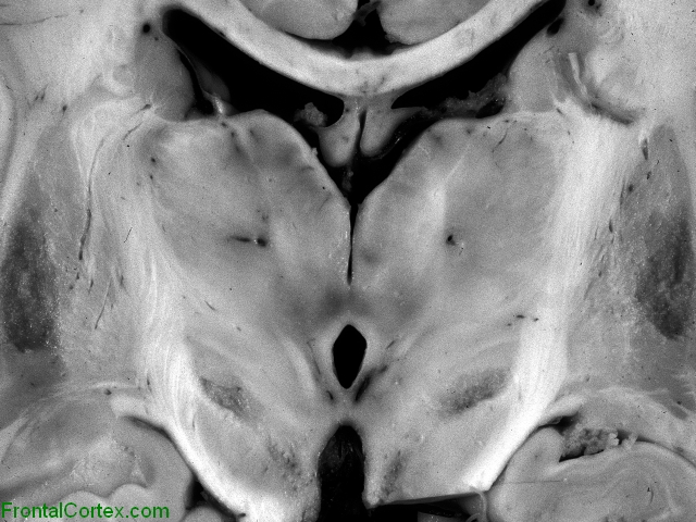 Leigh's disease, coronal section through basal ganglia