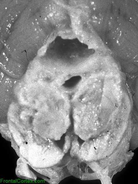 Leigh's disease, transverse section through midbrain