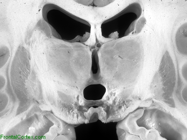 Leigh syndrome, coronal section through thalamus