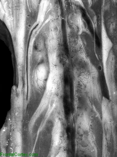 Medulloblastoma, leptomeningeal dissemination, ventral surface of spinal cord.