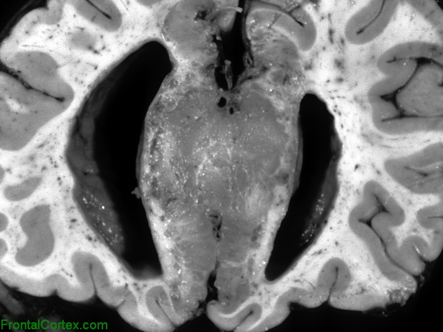 Lipoma Corpus Callosum Coronal