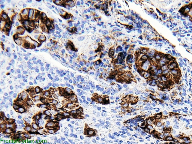 Lymphocytic Hypophysitis Synaptophysin IHC