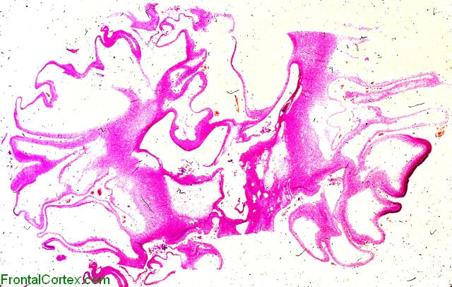 Multicystic encephalopathy, whole mount, H&E stain