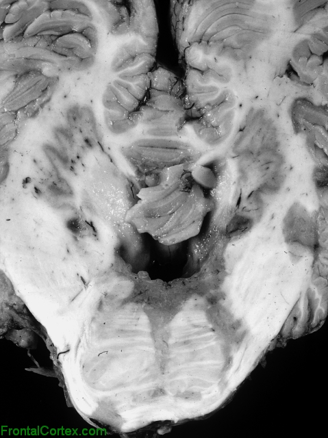 Multiple sclerosis, transverse section through pons and cerebellum