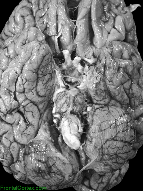 MSA-C Ventral Brain