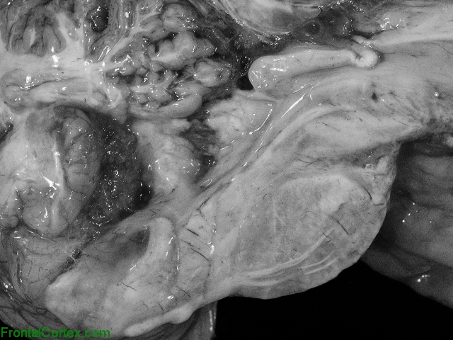 Longitudinally extensive transverse myelitis, extending into caudal brainstem, mid sagittal section of brain