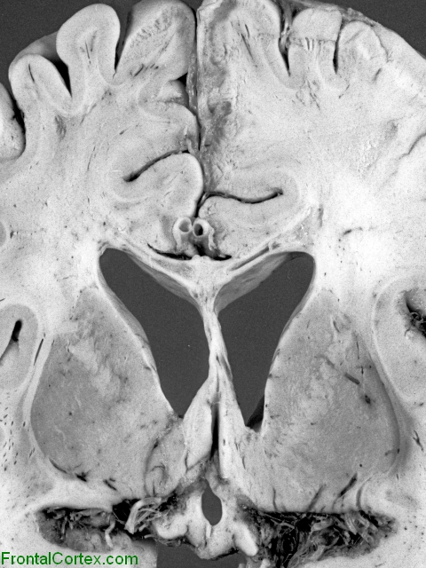 Machiafava-Bignami disease,Coronal sectioned through basal ganglia and cerebrum