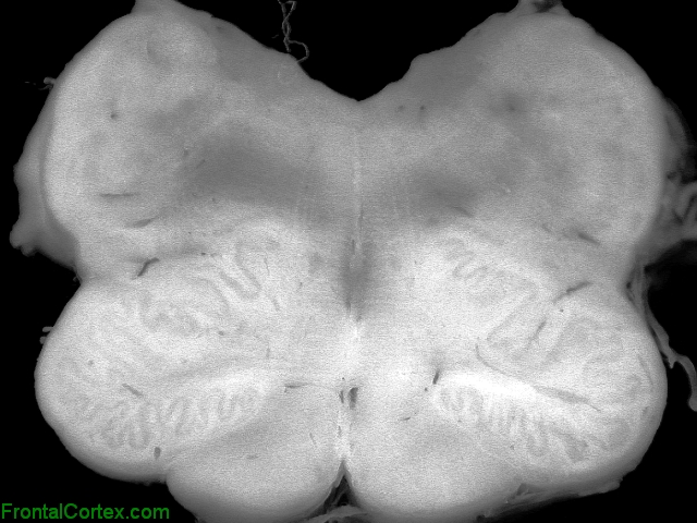 Medullary tegmental necrosis, transverse section of medulla