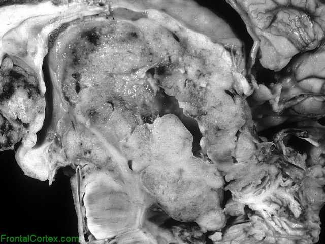 Medulloblastoma, mid sagittal section of brain