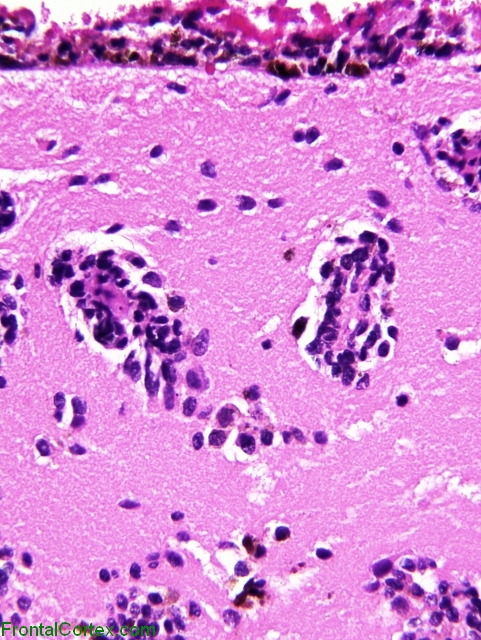 Meningeal Melanocytosis, H&E stain x 100