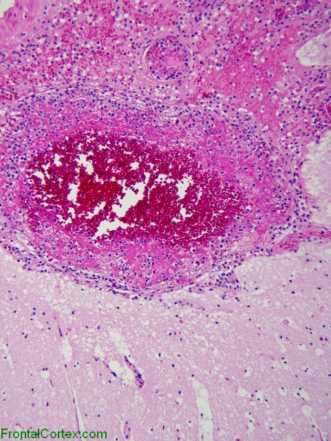 Meningeal Leukemia x200