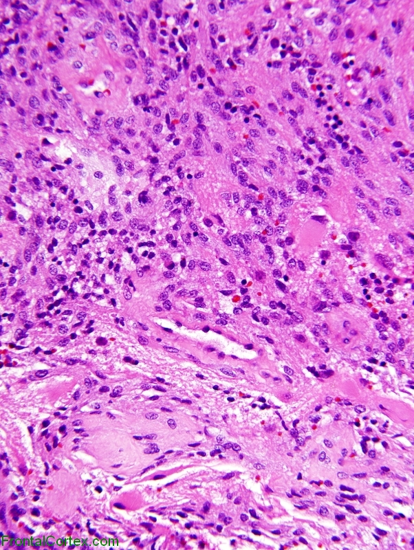 Meningioma invading brain, H&E stain.