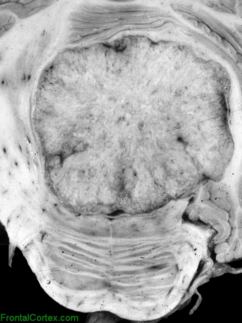 Metastatic carcinoma, filling and distending the fourth ventricle, transverse section.