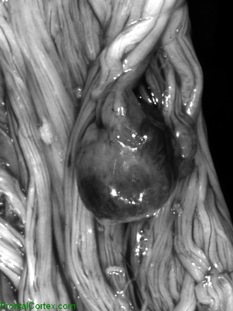 Metastatic carcinoma, cauda equina, gross photograph.