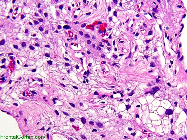 Microcystic meningioma, high power H&E stain.