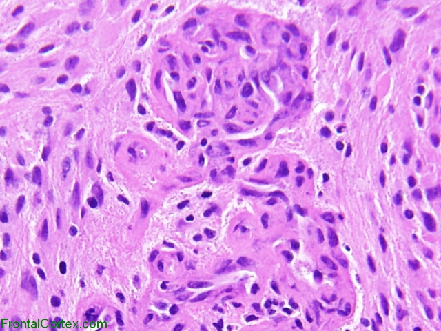 Glioblastoma multiforme, microvascular proliferation, H&E stain x 400.