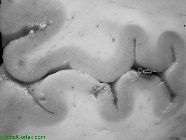 Miliary metastases ("carcinomatous encephalitis"), coronal section of brain, close-up