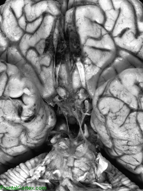 Mucormycosis, secondary to Zygomycetes infection, ventral surface of brain.