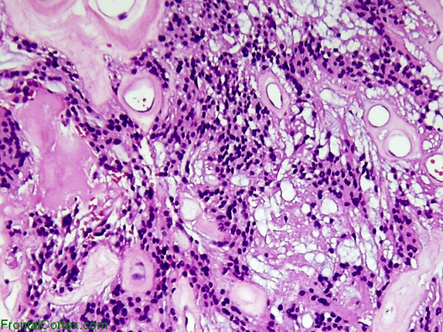 Myxopapillary Ependymoma H&E