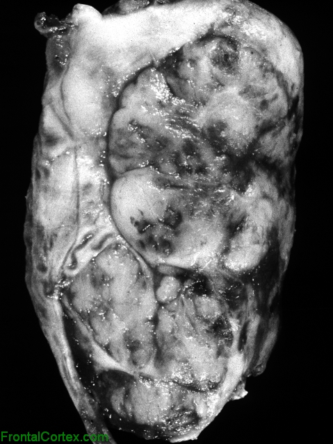 Myxopapillary Ependymoma, Sagittal Section