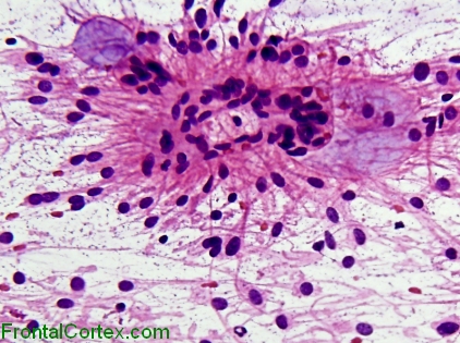 Myxopapillary Ependymoma, intraoperative smear preparation x 200