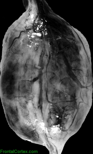 Myxopapillary Ependymoma, gross photograph of surgical resection