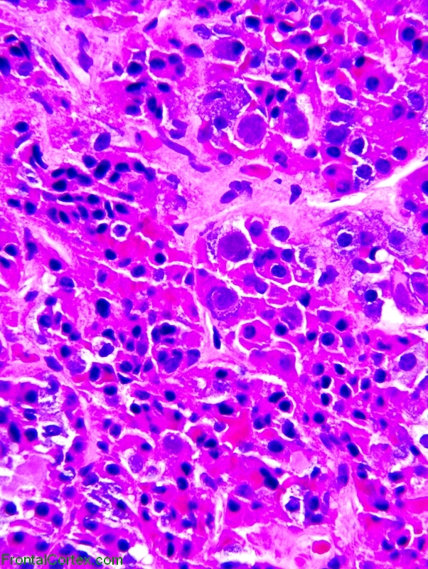 NONADENOMA 400x